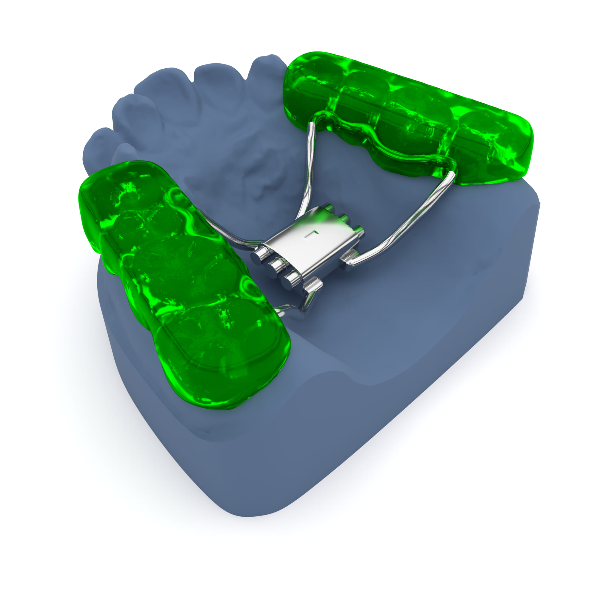 Disjunctor ancorat pe gutiere - Ortho Premium Lab